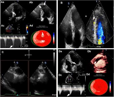 Case Report: Integrated echocardiographic assessment guided Liwen procedure for treating obstructive hypertrophic cardiomyopathy with ventricular aneurysm